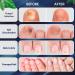 Extra Strength Toe Fungus Nail Treatment - Anti Fungal Care for Toenails & Fingernails - Buy Online on SooperMarket.com