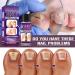 Fungal Nail Treatment 30ml Extra Strong Nail Fungus Treatment for Toenail and Fingernail Premium Fungal Nail Eliminator Anti fungus Nail Repair and Strengthen Fix & Renew Damaged Broken Nails - Buy Online on SooperMarket.com