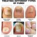 SenhE Fungus Laser Therapy Device Antibacterial Laser Equipment Light Therapy Device Fungal Nail Revolutionary High-Efficiency Light Therapy Device for Toenail Diseases  - Buy Online on SooperMarket.com
