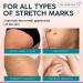 Stretch Mark Cream - Maternity Skin Care with Collagen, Jojoba, and Olive Oil - Prevents and Fades Stretch Marks - Hydrating Belly Lotion for Pregnant Women - 4 oz - Buy Online on SooperMarket.com