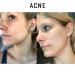 Buy Pure Organic Ozonated Olive Oil Extra Strength 1200 - Acne Anti-Aging Rosacea Treatment for Sensitive Skin - Made in Spain - Buy Online on SooperMarket.com