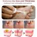 Xebular Foot Corn Removal Gel - Extra Strength Liquid for Toes - Callus & Corn Remover (3 PCS) - Buy Online on SooperMarket.com
