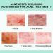 Anti-Acne Face Cream Spot Cream for Acne Treatment and Spot Treatment Skin Treatment Gel Cream For Face Blemishes & Blackheads Acne Treatment Cream Anti Acne Spot - Buy Online on SooperMarket.com