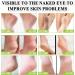 Urea 42% Foot Cream Cracked Heel Repair Cream For Feet and Hand Callus Remover For Dry And Hard Skin Hydrating Foot Moisterizer Nourishes Soften for Feet Knees Hand 100g - Buy Online on SooperMarket.com
