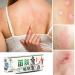 Herbal Anti-Itch Cream for Psoriasis, Dermatitis, Eczema - Multicolor, One Size - Buy Online on SooperMarket.com