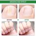 Nail Fungus Treatment For Toenail - Extra Strong Fungal Nail Treatment - Anti fungus Nail Repair and Strengthen Fix & Renew Damaged Broken Nails (2PC) - Buy Online on SooperMarket.com
