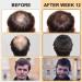 5% Minoxidil Foam Hair Regrowth Treatment for Men & Women - Stops Hair Loss, Promotes Follicle Growth - 2.11fl oz - Buy Online on SooperMarket.com