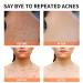 Salicylic Acid Acne Treatment Cream for Face & Body - Teens & Adults | Anti-Acne Moisturizer & Spot Treatment - Buy Online on SooperMarket.com
