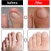 Ingrown Toenail Treatment - 30ml Ingrown Toenail - Cuticle Care Oils for Ingrown Toenails - Trimming Toenail Softening Drops Natural Ingrown Toenail Correction Treatment Fungal Nail Treatment - Buy Online on SooperMarket.com