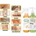 Anushka Foot Peeling Spray Oil | Quick Dead Skin Removal & Hydrating Exfoliation | Effective Callus Treatment - Buy Online on SooperMarket.com