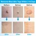 Painless 2-in-1 Skin Tag Removal Kit for Micro to Large Skin Tags (1-9mm) - Safe & Easy DIY Tool for Home Use - Buy Online on SooperMarket.com