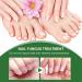 Nail Fungus Treatment For Toenail - Extra Strong Fungal Nail Treatment - Anti fungus Nail Repair and Strengthen Fix & Renew Damaged Broken Nails (2PC) - Buy Online on SooperMarket.com