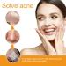 Pimple Patches for Face Hydrocolloid Surface Patches for Forehead Nose Chin and Cheeks Large Acne Treatment Patches for Pimple Extraction and Clean Pores Hydrocolloid Acne Patches for Acne Skin - Buy Online on SooperMarket.com