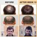 Minoxidil 5% Foam for Men with Biotin - Hair & Beard Growth Treatment (3 Pack) - Buy Online on SooperMarket.com