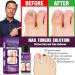 Fungal Nail Treatment 30ml Extra Strong Nail Fungus Treatment for Toenail and Fingernail Premium Fungal Nail Eliminator Anti fungus Nail Repair and Strengthen Fix & Renew Damaged Broken Nails - Buy Online on SooperMarket.com