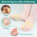 DYKOOK Bunion Corrector & Big Toe Straightener with Heel Strap for Pain Relief - 1 Pair Split Toe Separator for Hallux Valgus Corrector - Non-slip Bunion Protector - Beige (Small) - Buy Online on SooperMarket.com