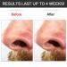 Nose Wax Kit for Men & Women - Hair Removal for Nose & Ear - 50g Wax Beads, 20 Applicators, 10 Paper Cups, 10 Mustache Guards - Buy Online on SooperMarket.com