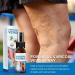 Varicose Veins Miracle Spray: Treatment for Legs to Improve Blood Circulation, Soothe Spider Veins and Relieve Tiredness - Buy Online on SooperMarket.com