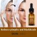 SKIN LABO SkinLabo Active Serum Aha + Bha Eliminates Surface Dead Cells Skin Perfecter with Exfoliating and Purifying Action 15 ml (Old Version) - Buy Online on SooperMarket.com
