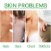 Trendyfave Dark Spot Correcting Glow Serum Skin Tag Removal Age Spot Remover For Face Scar Treatment Pore Minimizer Serums Skincare Contains Tea Tree Oil Vitamin E Body Acne Treatment 30ml - Buy Online on SooperMarket.com