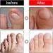 Ingrown Toenail Treatment and Removal Relief Oil - Nail Growth and Fungal Corrector - Buy Online on SooperMarket.com