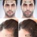 Beard Roller 0.5mm - Microneedle Dermaroller for Beard Growth & Care | 1 Pack - Buy Online on SooperMarket.com