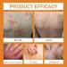 Bee Venom Psoriasis Cream Bee Venom Cream for Psoriasis New Zealand Bee Venom Body Care Chinese Herbal Cream Soothing Psoriasis Cream Body Cream for Redness & Itching & Soothing (1) - Buy Online on SooperMarket.com