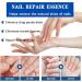 Fungal Nail Treatment 30ML Nail Fungus Serum for Toenail Extra Strong Gentle Anti Fungal Nail Serum Protects Thick Broken Discolored Nails Restoring Healthy Nails For Finger And Toe Nail Fungal - Buy Online on SooperMarket.com