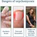Fungal Nail Treatment - Extra Strong Nail Fungus Treatment for Toenail and Fingernail - Fungal Nail Eliminator Anti fungus Nail Repair and Strengthen Fix & Renew Damaged Broken Nails 30ml - Buy Online on SooperMarket.com