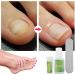 Ingrown Toenail Patch Ingrown Toenail Corrector Toenail Correction Patch Glue Toenail Patch with Elastic Gasket for Women Men Ingrown Toenail Kit (12 Pieces) - Buy Online on SooperMarket.com