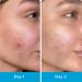 LitBear Pimple Patches | Invisible Hydrocolloid Acne Treatment | 66 Assorted Salicylic Acid Spot Covers for Whiteheads & Cystic Acne - Buy Online on SooperMarket.com