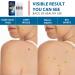 Extra Strength Skin Tag Remover | Wart Removal | Tag Dries and Falls Away | Natural Ingredients | All Skin Types - Buy Online on SooperMarket.com