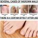 Ingrown Toenail Treatment - 30ml Ingrown Toenail - Cuticle Care Oils for Ingrown Toenails - Trimming Toenail Softening Drops Natural Ingrown Toenail Correction Treatment Fungal Nail Treatment - Buy Online on SooperMarket.com