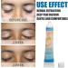 Vitiligo Cream 30G - Herbal Extract Treatment for White Spots & Skin Pigmentation - Creme Medix Leukoplakia Solution - 0.7oz - Buy Online on SooperMarket.com