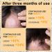 5% Minoxidil Foam Hair Regrowth Treatment for Men & Women - Stops Hair Loss, Promotes Follicle Growth - 2.11fl oz - Buy Online on SooperMarket.com
