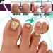 Fungal Nail Treatment 30ml Extra Strong Nail Fungus Treatment for Toenail and Fingernail Premium Fungal Nail Eliminator Anti fungus Nail Repair and Strengthen Fix & Renew Damaged Broken Nails - Buy Online on SooperMarket.com