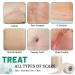 3 Rolls Silicone Scar Sheets(1.6" x 60" Each) Silicone Patches for Scars Reusable Scar Removal Strips for Prevention and Repair - Buy Online on SooperMarket.com