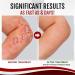 Kolmax Psoriasis Relief Spray - Dermax Treatment, Soothing Coal Tar Cream (3Pcs) - Buy Online on SooperMarket.com