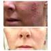 Glycolic Acid 20% Resurfacing Pads with Vitamins B5, C & E - 50 Peel Pads for Smooth Skin, Reduce Wrinkles - Buy Online on SooperMarket.com