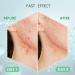 AUSLKA Pimple Patch (9 Patches) - Hydrocolloid Zit Patches for Face - Blemish & Acne Treatment Stickers - Buy Online on SooperMarket.com