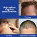 Scalpicin Max Strength Scalp Itch Treatment 1.5 oz - Effective Relief for Itchy Scalps | Buy Online Internationally - Buy Online on SooperMarket.com