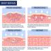 Silicone Scar Tape for Surgical Scars - Extra Long Scar Sheets for C-Section (59 in x 1.5 in) - Buy Online on SooperMarket.com