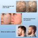 Derma Roller Beard Growth Kit - 540 Titanium Microneedling Roller for Face & Beard Growth - Includes Travel Case - 0.5mm - Buy Online on SooperMarket.com