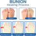 Orthopedic Bunion Relief Socks - Toe Alignment & Compression for Bunions - 5/10 Pairs - Buy Online on SooperMarket.com