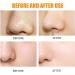 10pcs Hydrocolloid Blackhead Removal Patches | Deep Cleansing Pore Strips for Face, Nose, and Pores | Dermatologist Approved | Overnight Use - Buy Online on SooperMarket.com