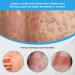 ZJchao 2pcs 30ml Psoriasis Relief Solution Spray - Effective Itch Relief Treatment for Skin, Hand, and Foot - Buy Online on SooperMarket.com