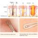 ME MAXEQUIP Blackhead Remover Pimple Popper Blemish Comedone Extractor Acne Tool Pimple Spot Popper Komedon Double Side Soft Touch and No-Slip Skincare for Whitehead Removal Stainless Steel - Buy Online on SooperMarket.com