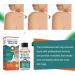 Skin-Tag-Remover Kit Remover for Verruca-Treatment - 30ml - Buy Online on SooperMarket.com