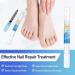 XIFEPFR Toenail Repair Pen - Nail Fingernail Repair Pen for Thick  Broken  Discolored Nails - Restores Healthy Strong Nails - 4PCS - Buy Online on SooperMarket.com