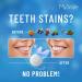 MySmile Teeth Whitening Kit with LED Light - Fast Non-Sensitive Whitener with 3 Carbamide Peroxide Gels - Remove Stains from Coffee, Smoking, Wine & Food - 10 Min Treatment - Buy Online on SooperMarket.com